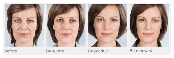 Sculptra before and after photos