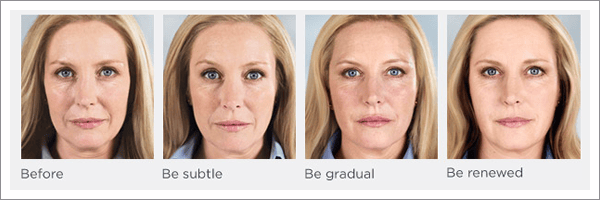 Before and After Photos for Sculptra