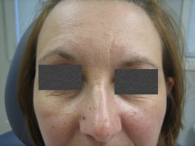 botox-brow-before