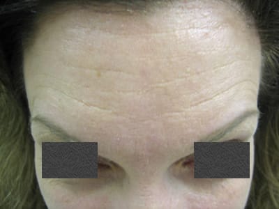 botox-forehead-after