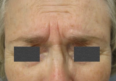 Before - Treatment of Scowl Lines (Eleven Lines)