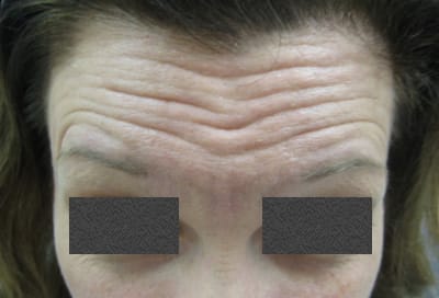 botox-forehead-before
