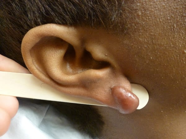 ear-lobe-repair-2-before