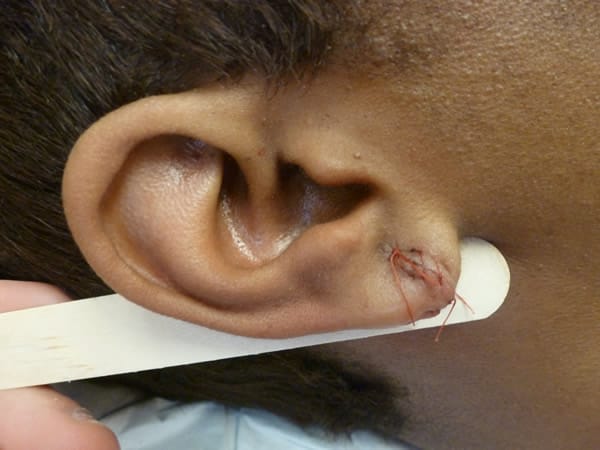ear-lobe-repair-2-surgery