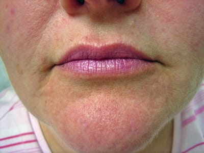 restylane-mouth-after