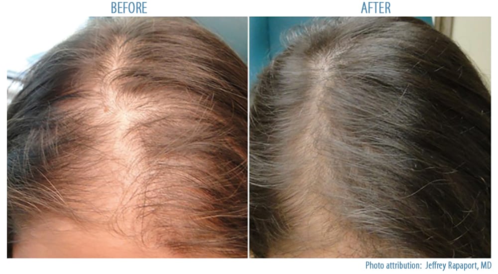 PRP Hair Loss Treatment | Before and After