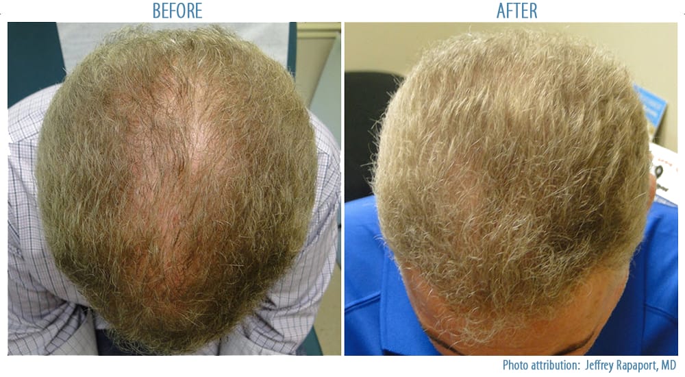How Can PRP Help with my Hair Loss by Stimulating Hair Growth?