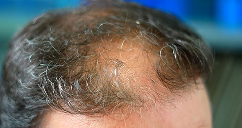 How Can PRP Help with my Hair Loss by Stimulating Hair Growth?