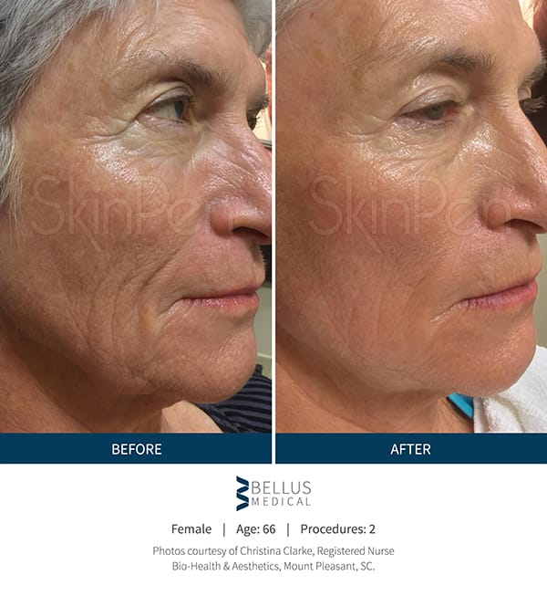 Microneedling - skinpen-before-after